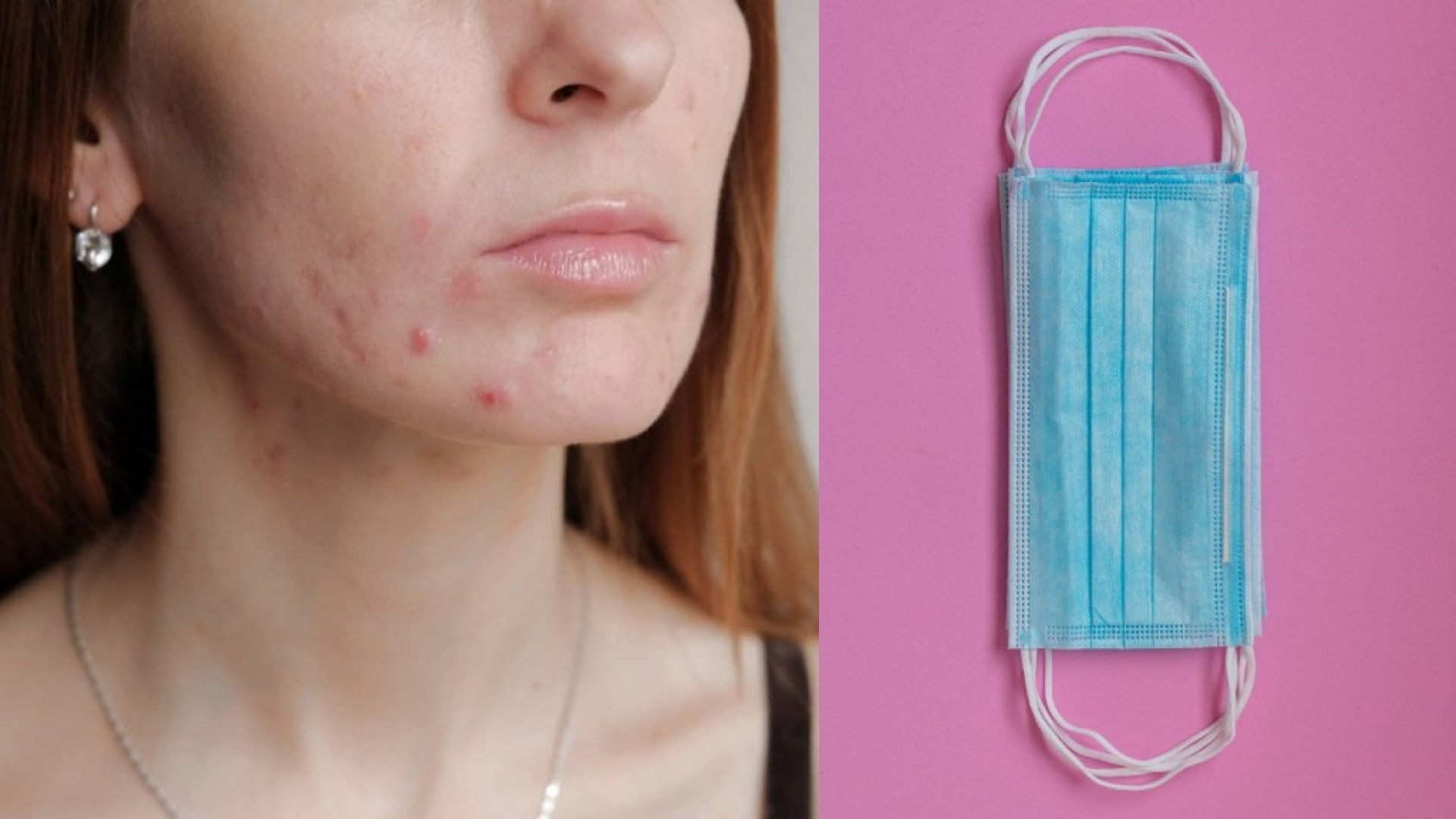 ¿Cómo prevenir acné causado por el cubrebocas?