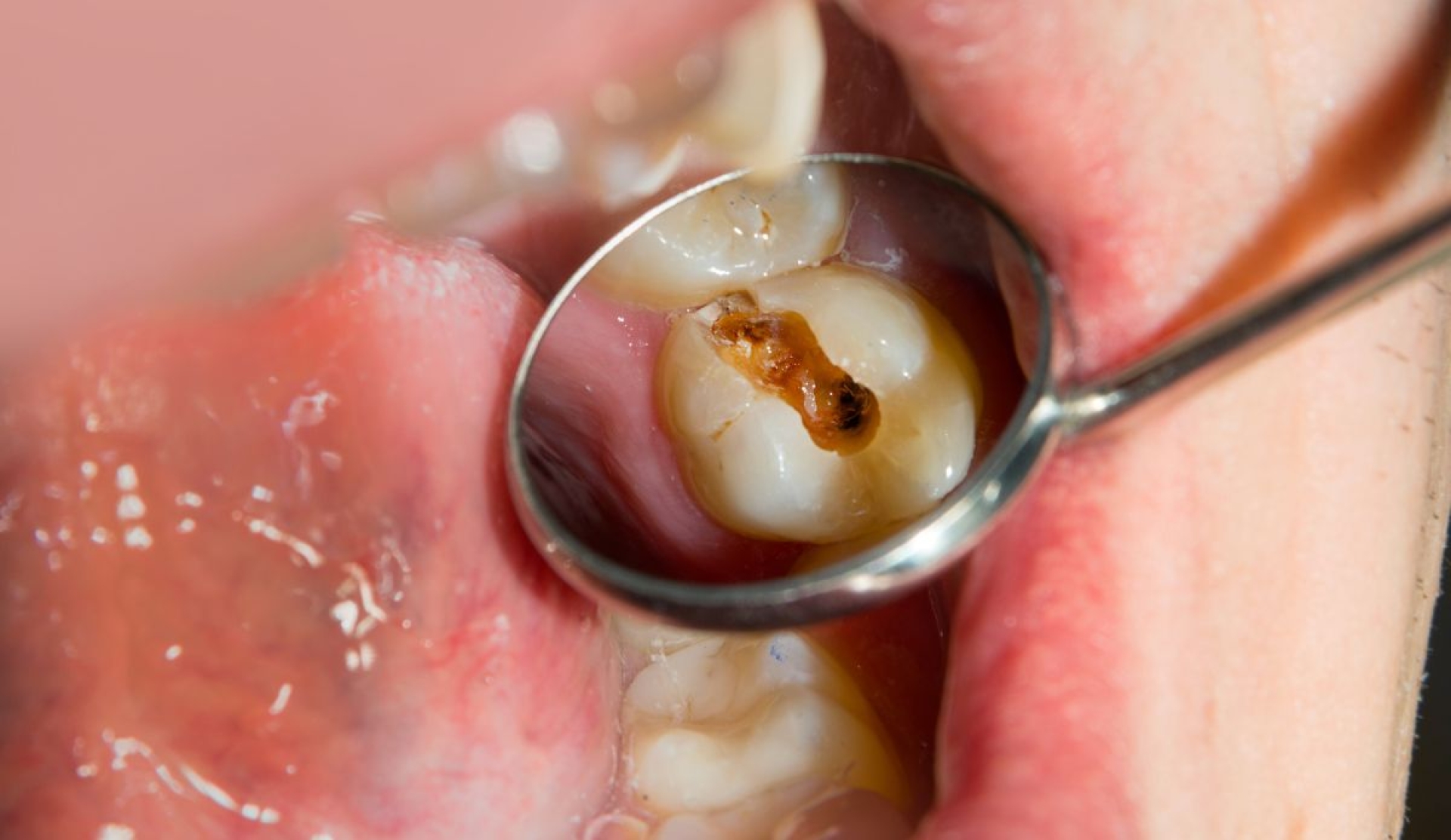 ¿Pueden las caries convertirse en un riesgo mortal para la salud?