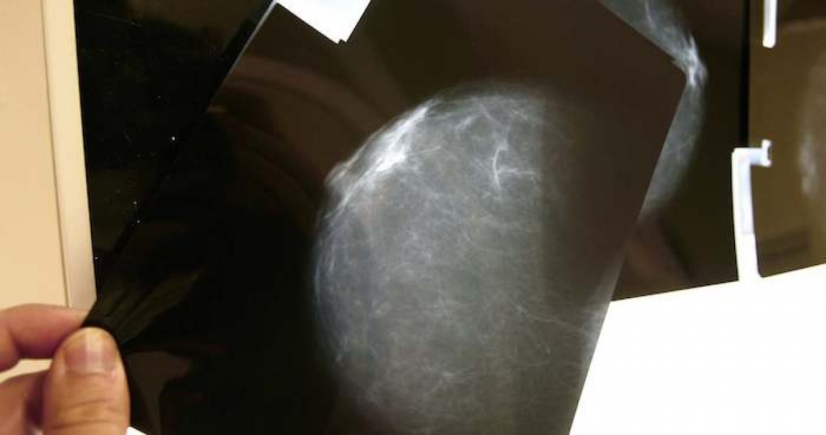 Científicos encuentran fármaco que reduce la expansión del cáncer de mama más agresivo