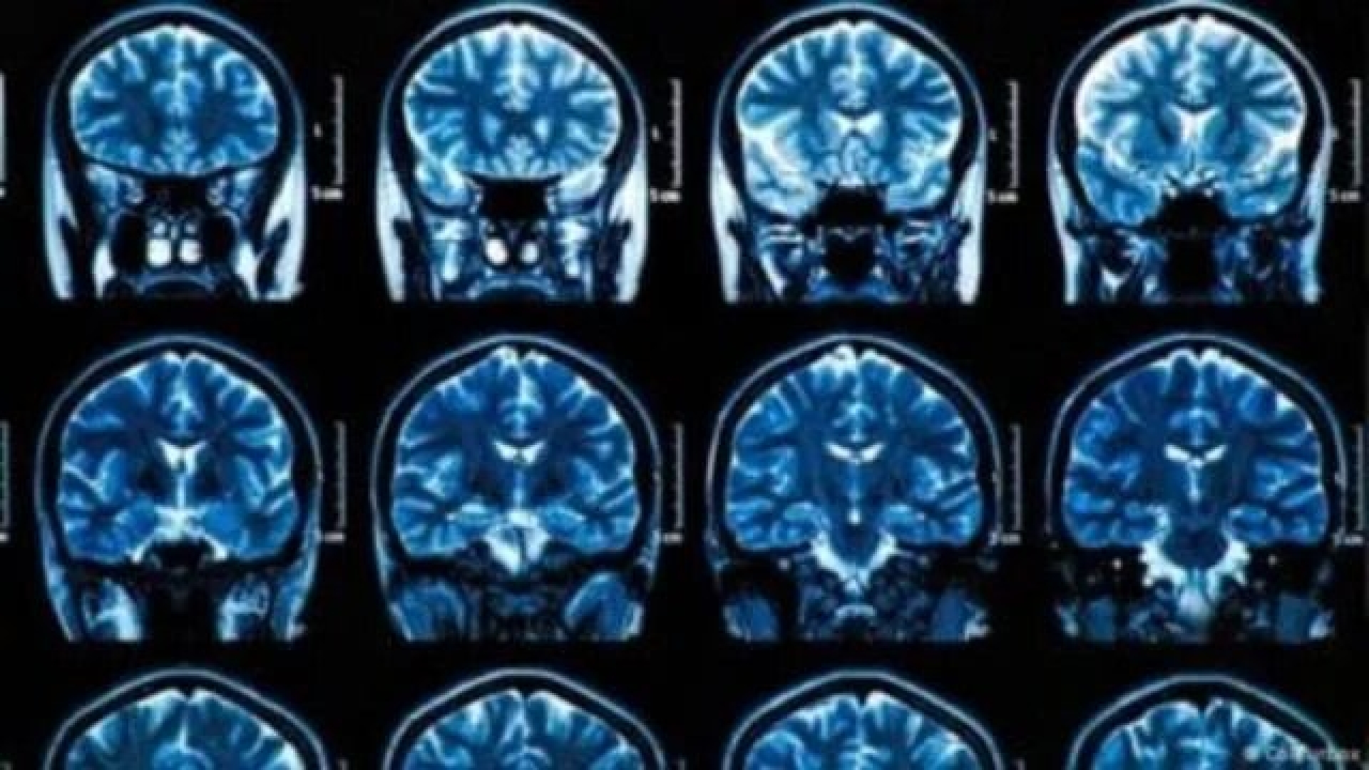 Identifican proteínas clave para tratamientos personalizados de esquizofrenia