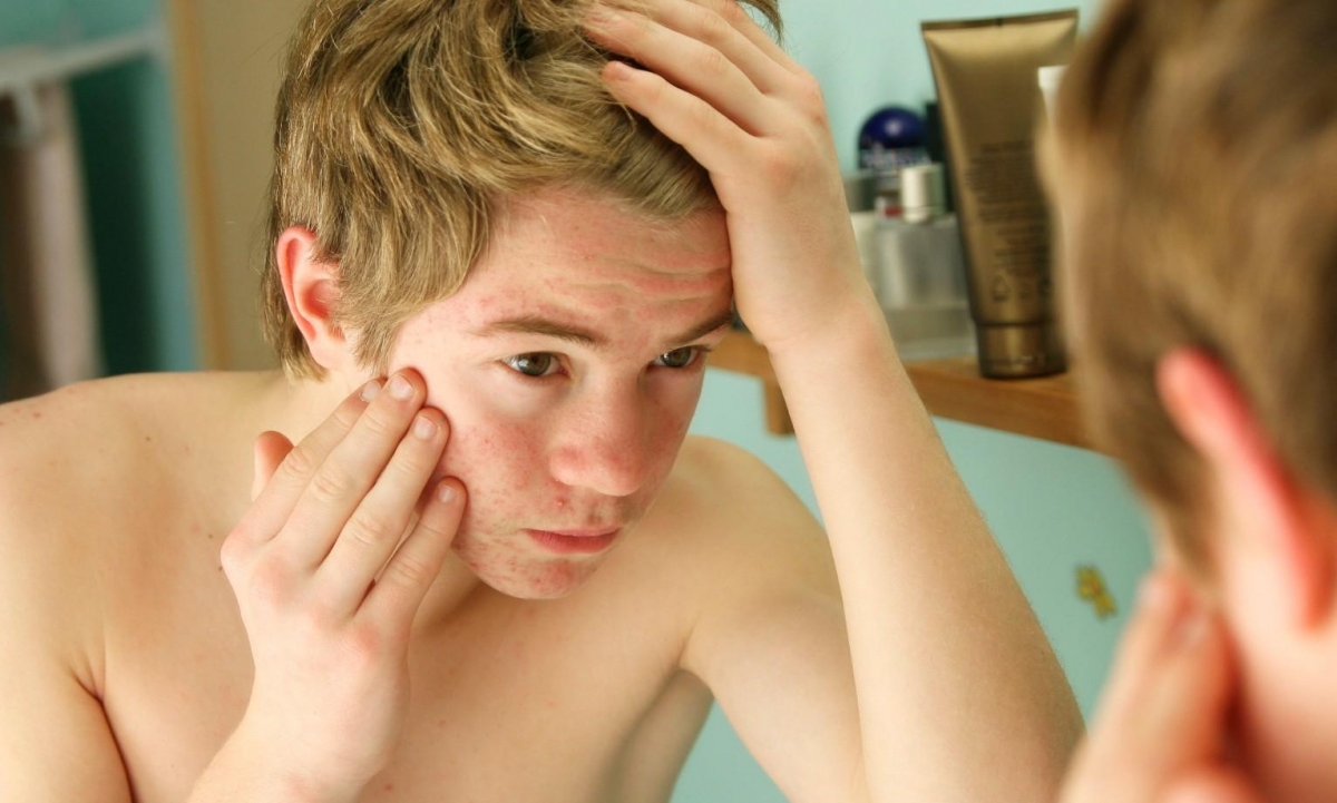 Alimentos para eliminar el acné
