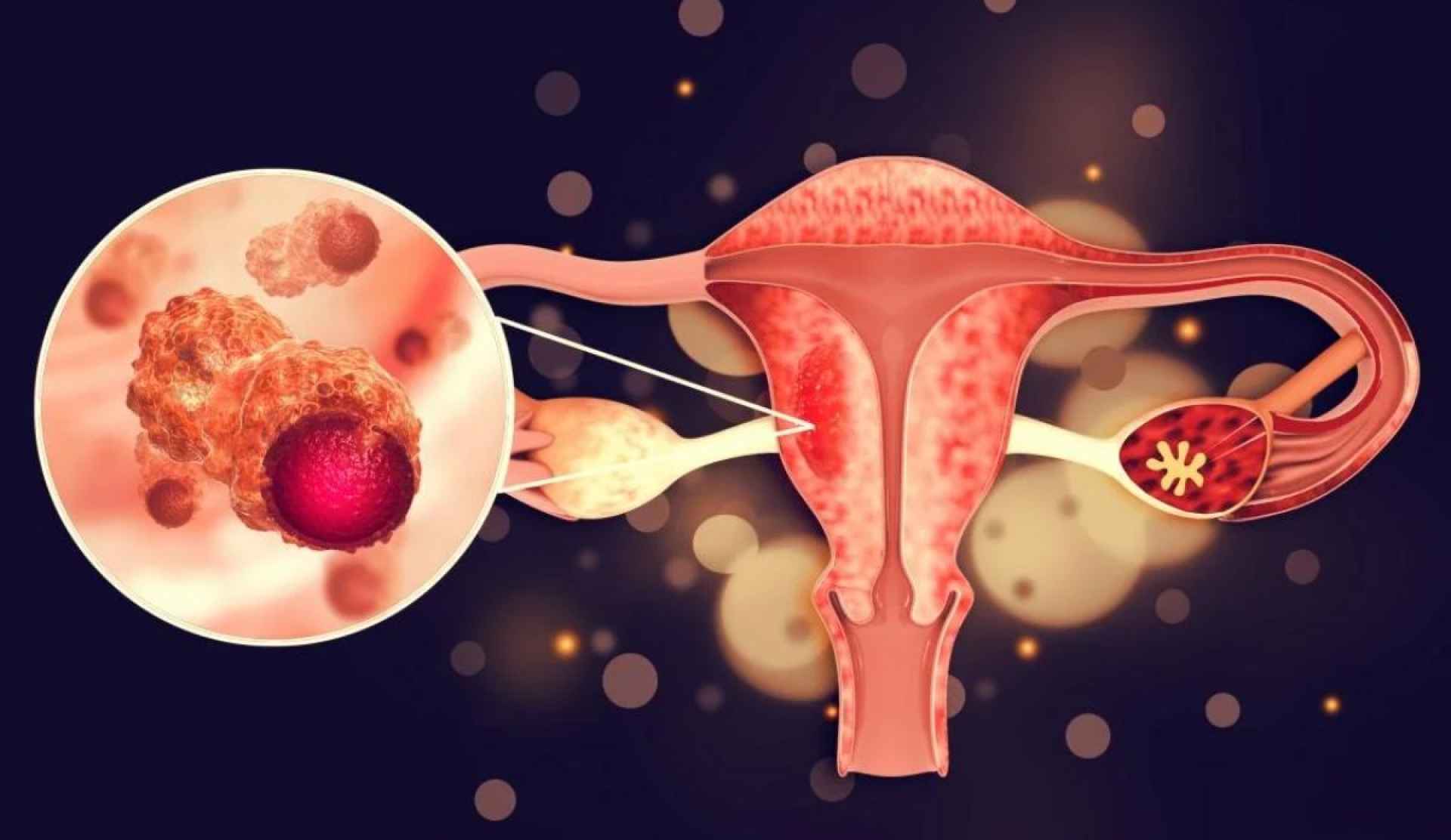 Un reto para la prevención del cáncer cervicouterino en México: el seguimiento de las mujeres positivas al VPH y lesión pre-maligna en cérvix