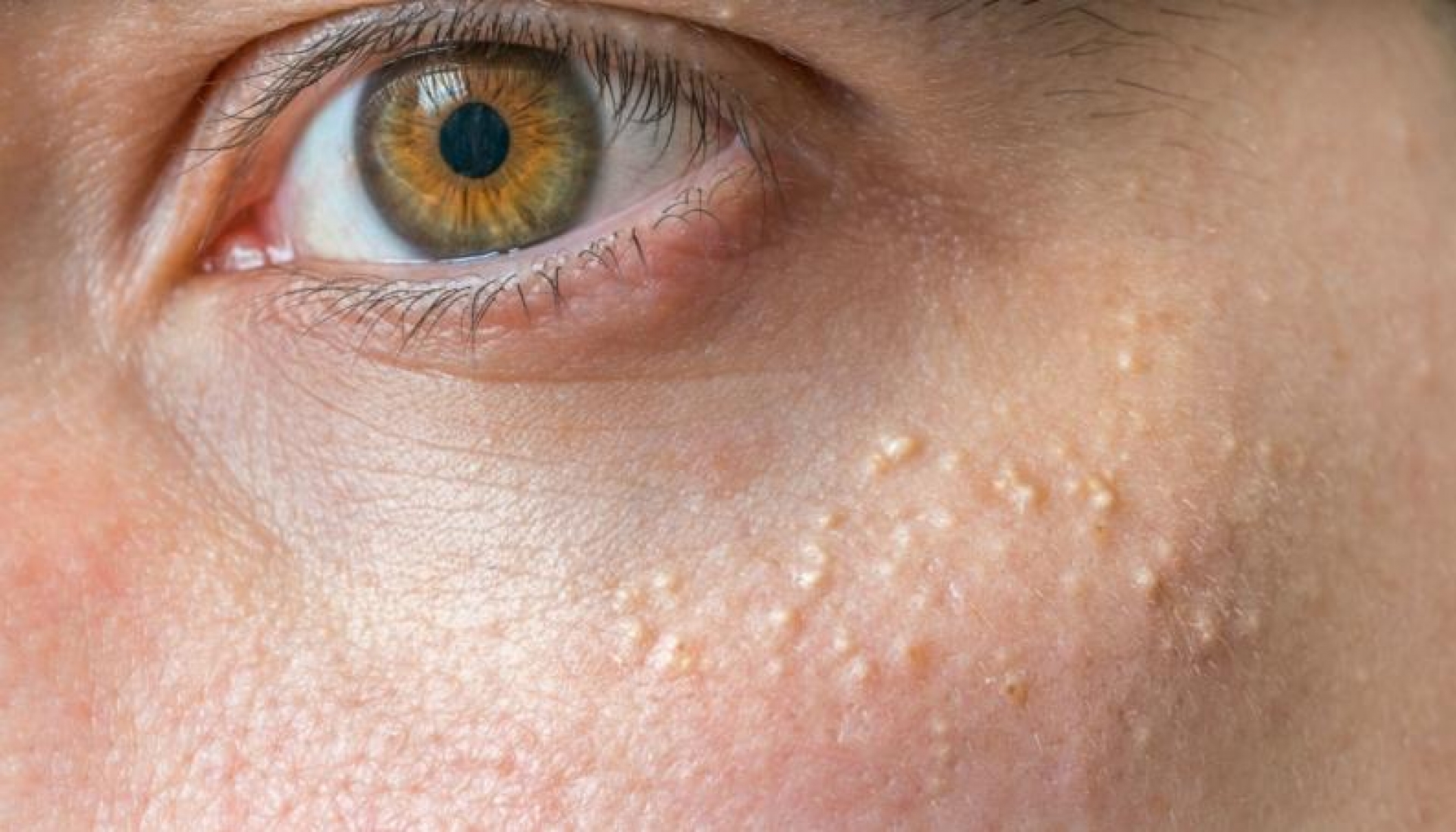 Puntitos blancos en el rostro: esta es la única forma segura de quitarlos