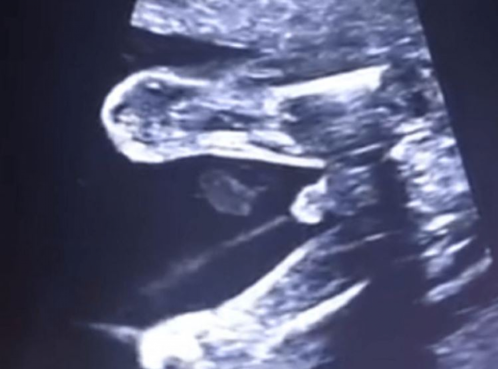 Bebé hace pipí dentro de la pansa de su mamá y lo captan en ultrasonido