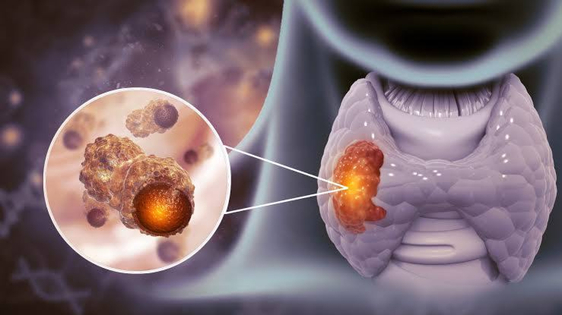 Día Mundial del Cáncer de Tiroides: Prevención y Conciencia Esencial.