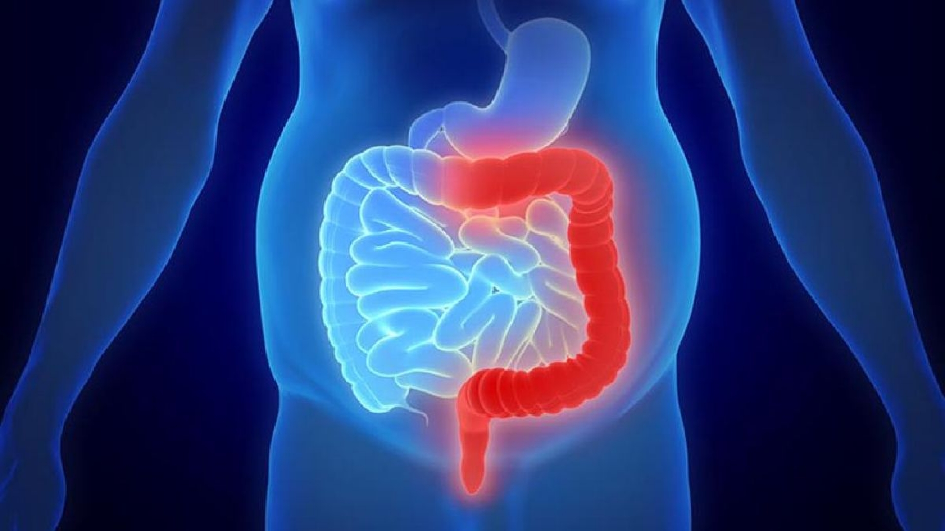 Enfatizan importancia de detección oportuna de colitis ulcerosa