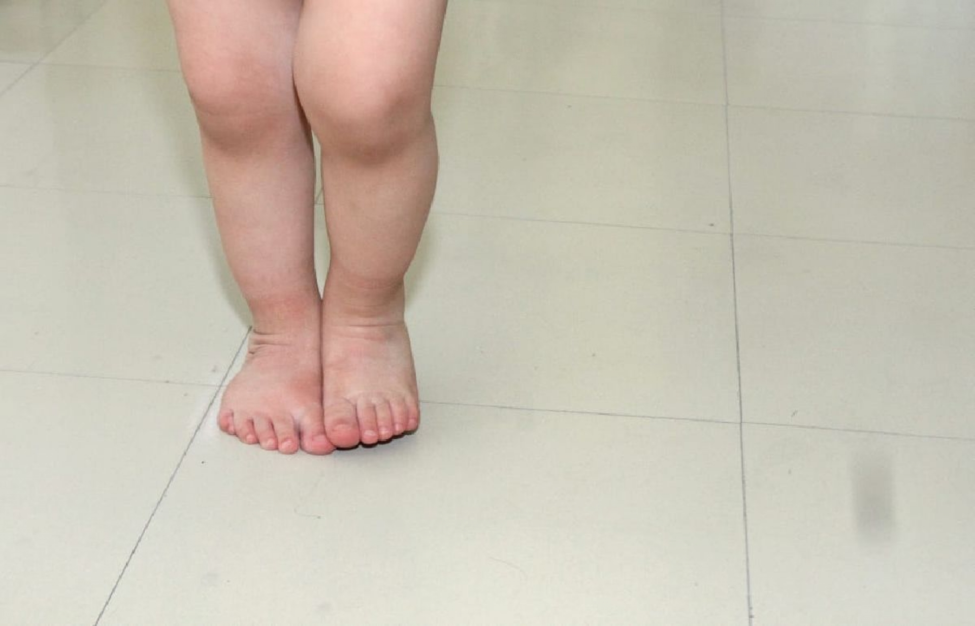 IMSS brinda tratamiento del pie plano en la infancia para evitar problemas en la vida adulta