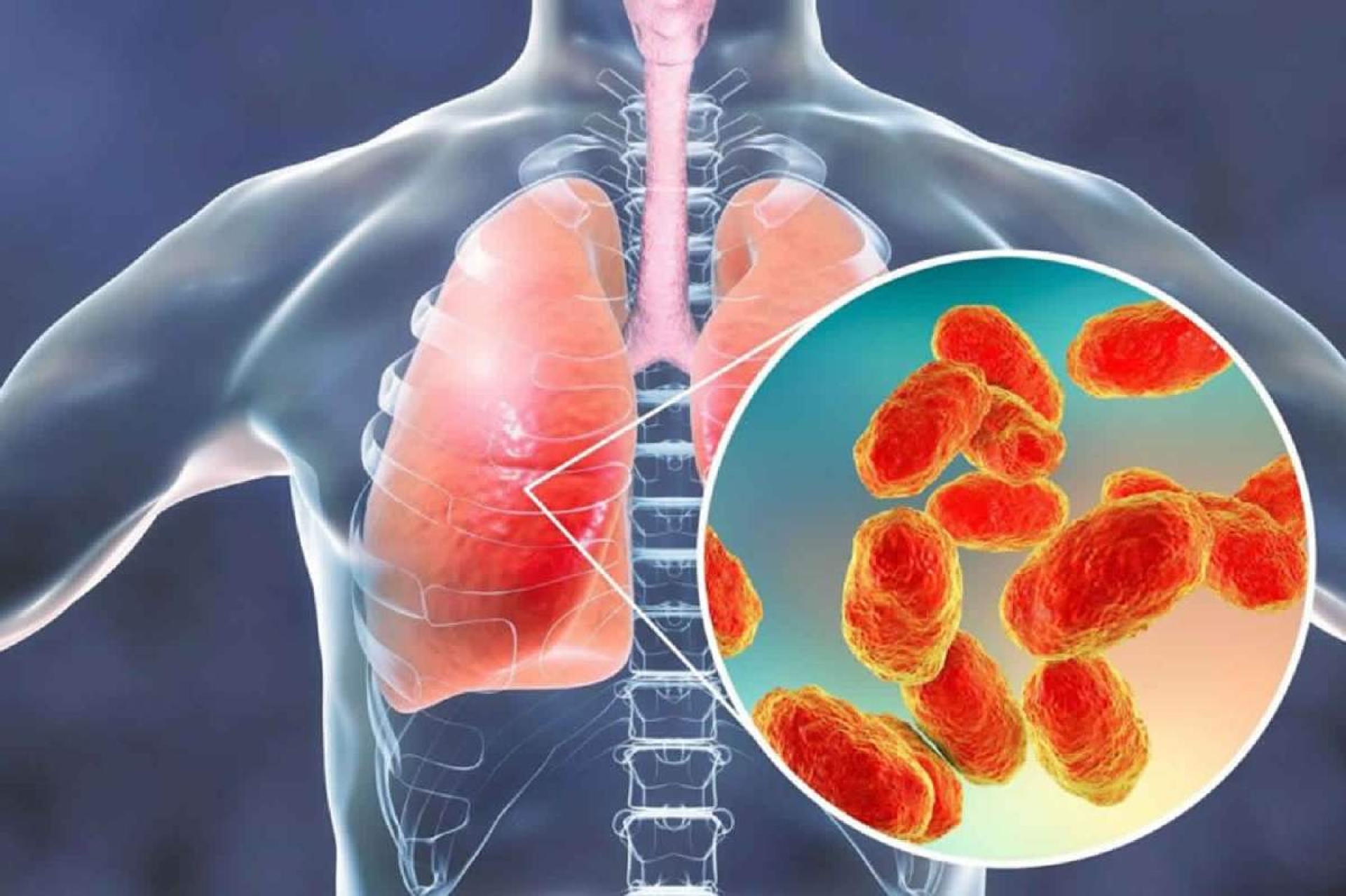 Confirman casos de Metapneumovirus humano en México
